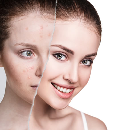 Common Questions About Accutane