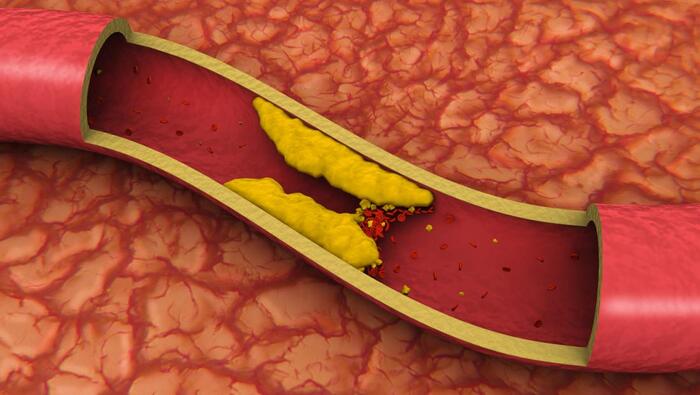 How Clogged Arteries Cause Erectile Dysfunction
