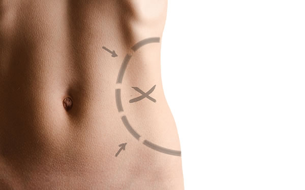 Preparing for Your Liposculpture Surgery