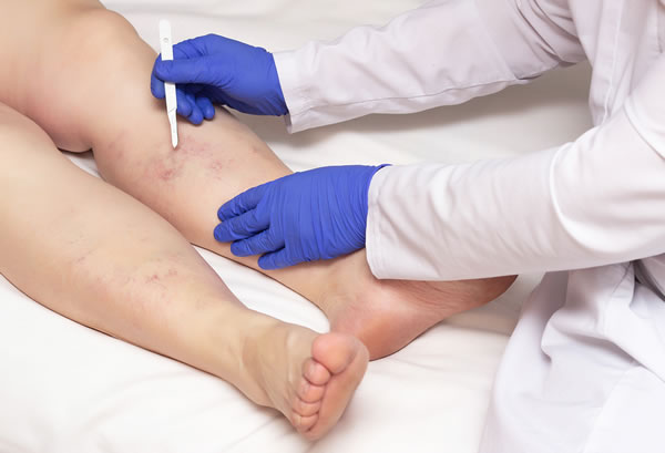 Why Winter Is the Best Season for Vein Treatment