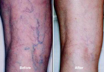 Vein Therapy in Sandy Springs
